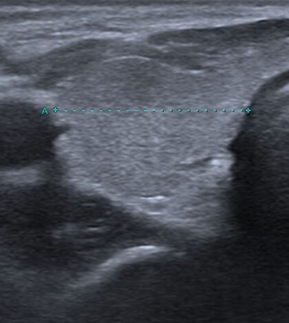 亜急性甲状腺炎の治療前と治療後の超音波画像所見：治療後