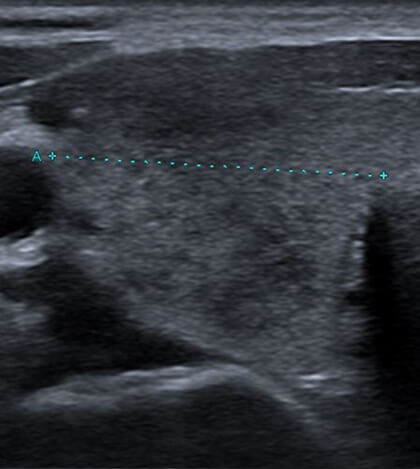 亜急性甲状腺炎の治療前と治療後の超音波画像所見：治療前